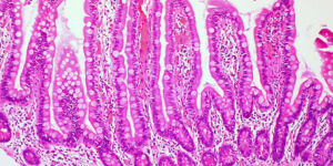 All disease begins in the (leaky) gut