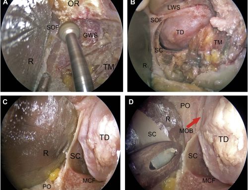 “Sagittal Crest”: Definition, Stepwise Dissection, and Clinical Implications From a Transorbital Perspective